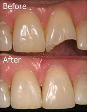 tooth filling material