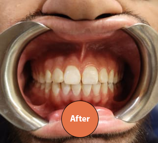 Teeth Whitening Before and After