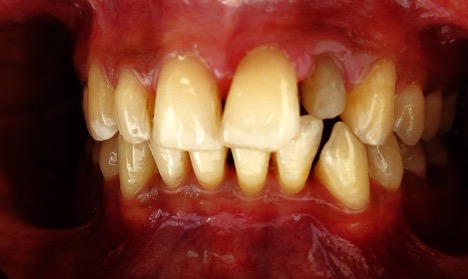 Zirconia crown in Lahore