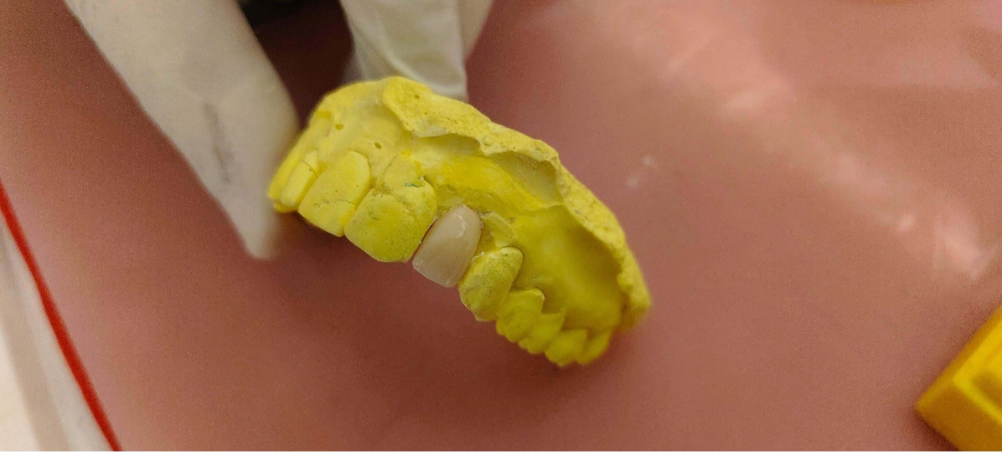 Zirconia crown in Lahore