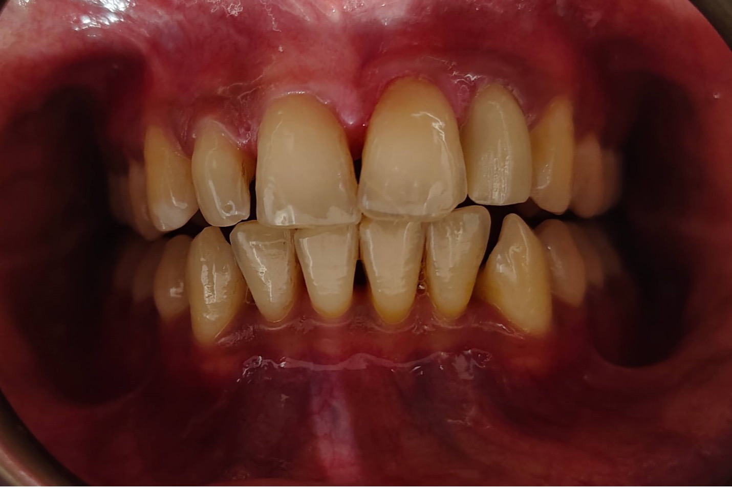 Best Dental Crown in Lahore