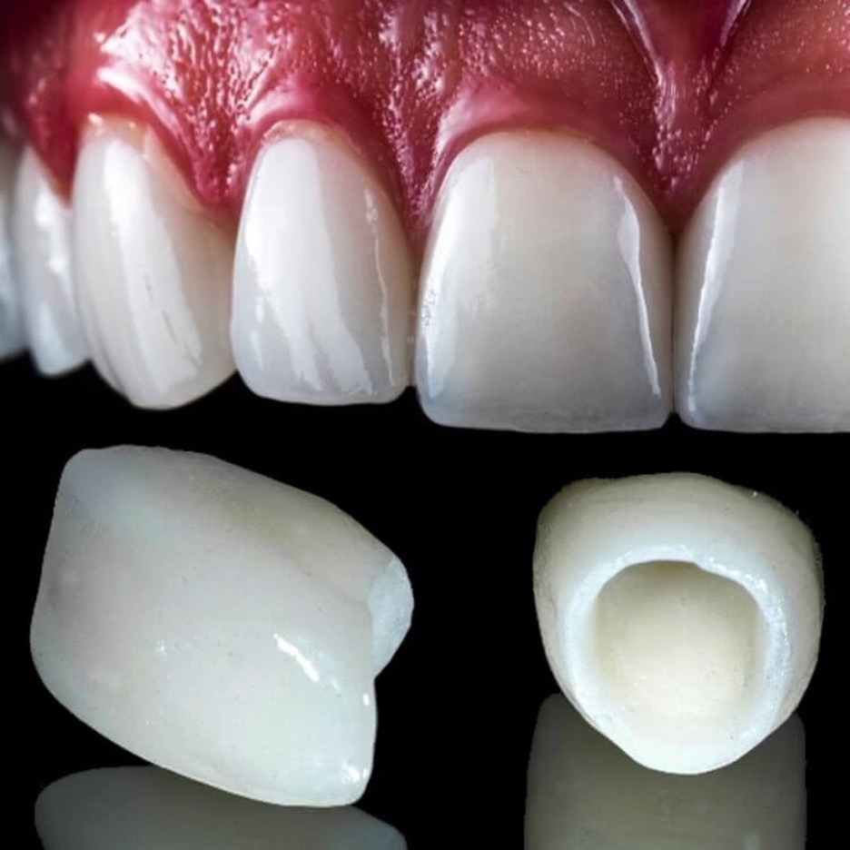 E- Max crown in Lahore