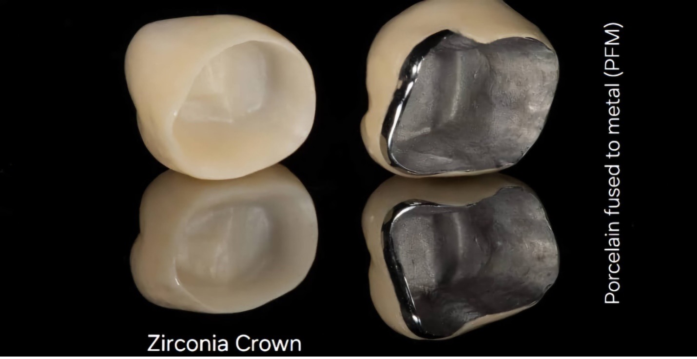 Cheap Dental Crown in Lahore