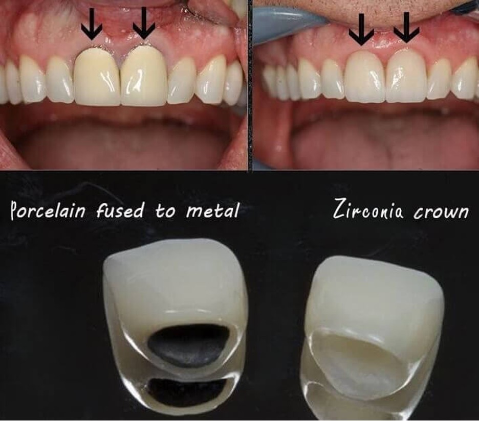 Differance between Zirconia and Porcelain crown